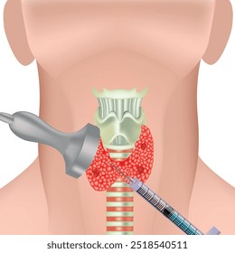 Punción tiroidea. Afiche médico. Ilustración vectorial