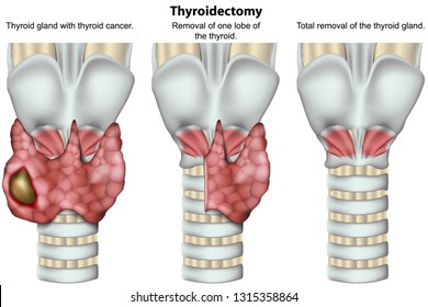 thyroid thyroidectomy tiroide tiroidectomia chirurgia endoscopic operasi alomedika tumore transoral gland ghiandola