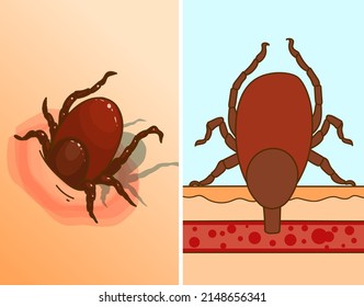 Tick bite. Discover a tick on the skin.  Healthcare illustration. Medical infographic. Vector illustration