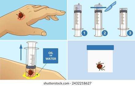 Picadura de garrapata. Cómo quitar la garrapata.  Ilustración sanitaria. Infografía médica. Ilustración vectorial.