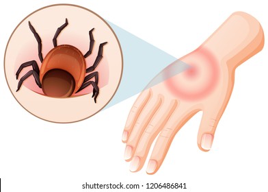 Tick bite human hand illustration