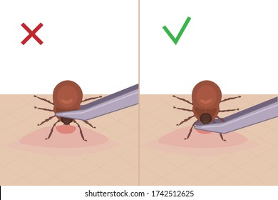 A tick bites a person. How to remove a tick from the skin. A parasite carrying a disease. Vector illustration