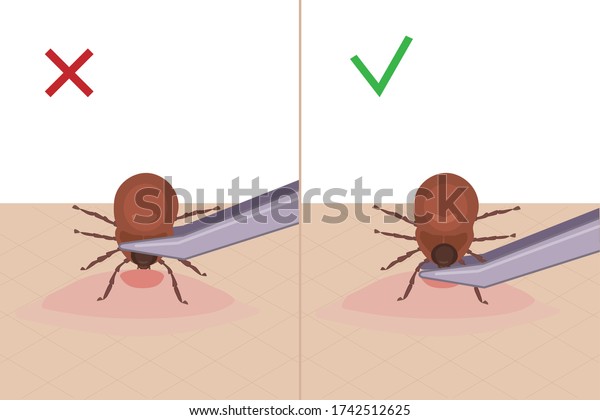 A tick bites a\
person. How to remove a tick from the skin. A parasite carrying a\
disease. Vector illustration