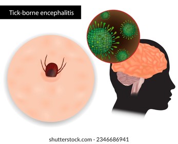 Tick-borne encephalitis or TBE. Viral infectious disease involving the central nervous system. Sheep ticks or Ixodes ricinus
