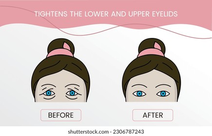 Tightens the lower and upper eyelid, laser cosmetology before procedure and after applying treatment. Illustration of a woman with and without wrinkles