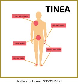 Vector de Línea. Tipos De Cartel De Línea, Ilustración, Infografía. Vector de enfermedad de la piel, volante, afiche, fondo. Tinea Versicolor, Manuum, Cruris, Pedis, Unguium. Diagrama de tipos de línea. infecciones fúngicas