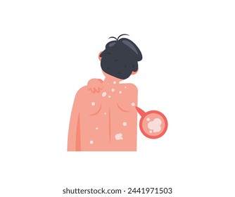 tinea versicolor appears all over the back. diseases that arise due to fungal infections. a man felt itching on his back due to tinea versicolor. health problems. cartoon illustration design. graphic