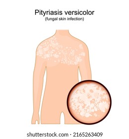 Tinea versicolor. Human body with symptoms of pityriasis versicolor. Close-up of skin that affected by a fungus. vector illustration