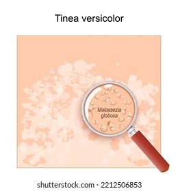 Tinea versicolor. Human skin with symptoms of pityriasis versicolor. Close-up of Malassezia globosa fungus that caused of skin diseases like tinea flava or lota. Yeast under a magnifying glass. Vector