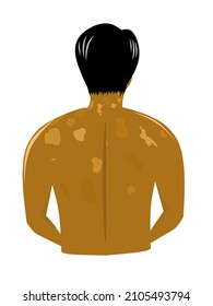 Tinea versicolor on the neck and shoulders of a man