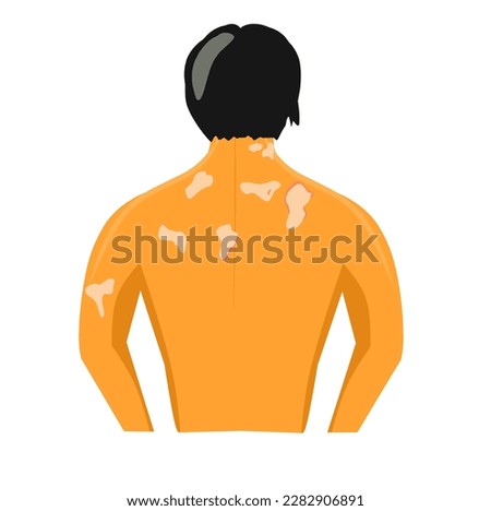 Tinea versicolor on the neck and shoulders of a man