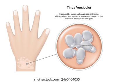 Tinea versicolor. Pityriasis versicolor is a common fungal infection of the skin. Close-up of Malassezia globosa fungus.