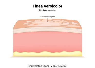 Tinea versicolor. Pityriasis versicolor. Fungal skin infection. Cross section of a human skin with Malassezia grows rapidly on the surface of the skin.