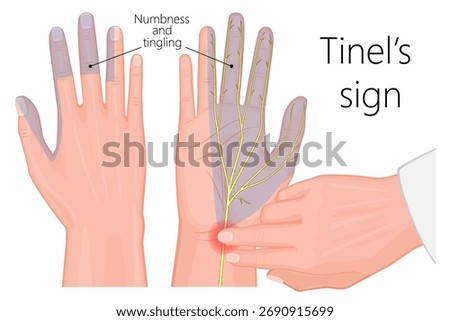 Tinel's test of the hand. Carpal tunnel syndrome diagnosis. Realistic vecror illustration.