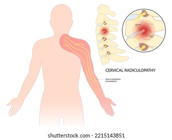 Tingling Numbness hand of spine degeneration thoracic neck root injury outlet pain damage canal syndrome Herniation traumatic bone disk spurs painful Spinal cord pinched nerves