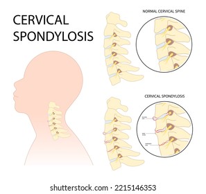 Tingling Numbness hand of spine degeneration thoracic neck root injury outlet pain damage canal syndrome Herniation traumatic bone disk spurs painful Spinal cord pinched nerves