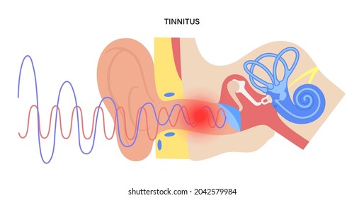 Tinnitus disease concept. Pain, inflammation in human ear. Symbol of earache, ringing and loud sounds in ears. Medical checkup of hearing organs, neurology problems treatment flat vector illustration.