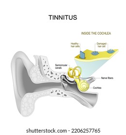 Tinnitus. Human ear. part of Auditory system. Inside the cochlea. Close-up of Healthy and Damaged hair cells system. Vector illustration.