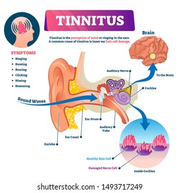 Tinnitus vector illustration. Labeled shingles noise perception problem. Ear structure scheme with inner hair cell damage. Illness symptoms list and cochlea closeup. Ringing feeling medical diagnosis.