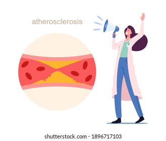 Tiny Medic Female Character Yell to Megaphone near Huge Blood Vessel Blocked with Cholesterol Plaque. Doctor Alert of Atherosclerosis Danger, Health Care Infographics. Cartoon Vector Illustration