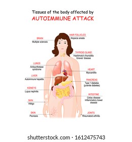 tissues of the body affected by autoimmune attack. Vector illustration for medical use