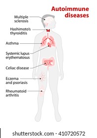 Tissues of the human body affected by autoimmune attack. Disease and organs on silhouette man
