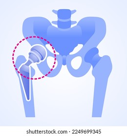 Titanium joint. Total hip replacement or arthroplasty. Structure of the artificial hip joint. Hip implant. Vector illustration