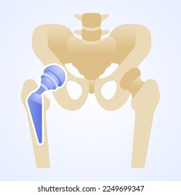 Titanium joint. Total hip replacement or arthroplasty. Structure of the artificial hip joint. Hip implant. Vector illustration