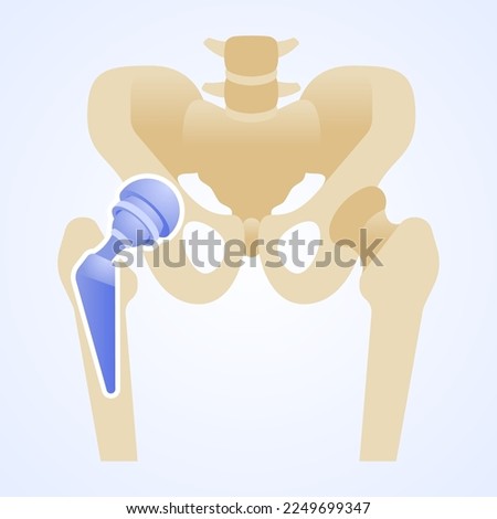 Titanium joint. Total hip replacement or arthroplasty. Structure of the artificial hip joint. Hip implant. Vector illustration