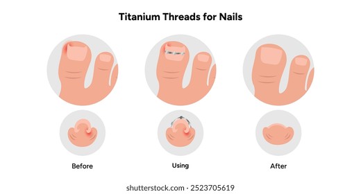 Fios de titânio para unhas, podólogo	