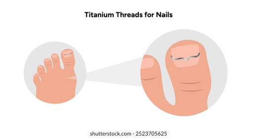 Titanium threads for nails, podiatrist	