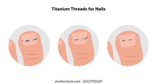 Titanium threads for nails, podiatrist	