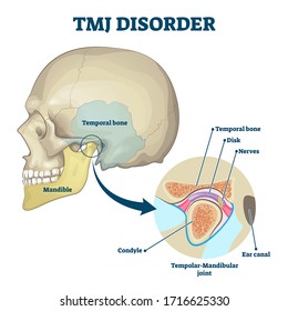 TMJ disorder vector illustration. Labeled jaw condition educational scheme. Diagram with joint clicking and pain anatomical structure and explanation. TMJD syndrome with mandibular movement closeup.