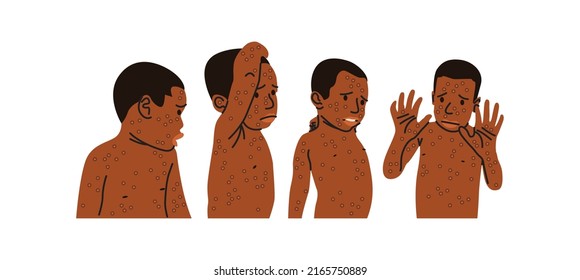 Today there are various kinds of diseases around us, one of which is monkeypox. The smallpox outbreak was confirmed in several parts of the world as early as 2022.