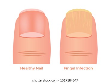 toe nail fungal infection vector