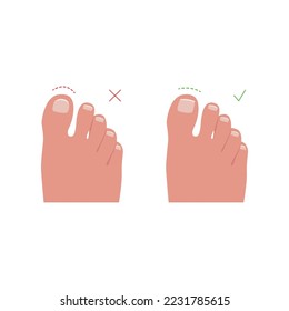 Toe nails cutting vector illustration. Flat image of wrong and right trimming to prevent ingrown nails. Onychocryptocosis, medical infographic, healthcare concepts.