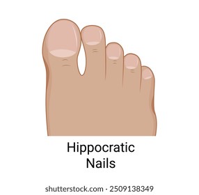 Toenail clubbing or hippocratic nails on the foot.