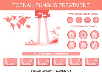 Toenail fungus treatment medical infographics. Vector cartoon flat illustration of infection, symptoms and therapy of nail and stop disease.