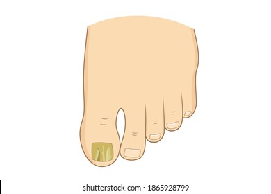 Toenail green mycosis vector illustration. Toe nails health, feel fungus, body care