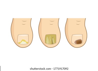 Toenail mycosis types. vector illustration. Toe nails health, feel fungus, body care