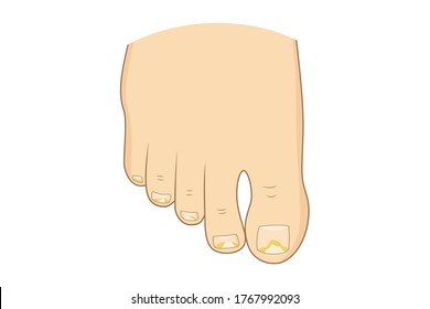 Toenail mycosis vector illustration. Toe nails health, feel fungus, body care