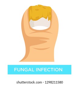 Toenail suppuration fungal infection toe damage vector nail removal disease or illness isolated body part medicine and treatment fungus medication and healthcare beauty or cosmetology problem.