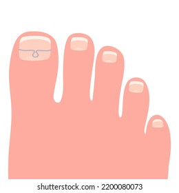 Toes on the right foot with a titanium staple on the thumb for correction of the shape of the toenail cartoon vector illustration isolated on a white background