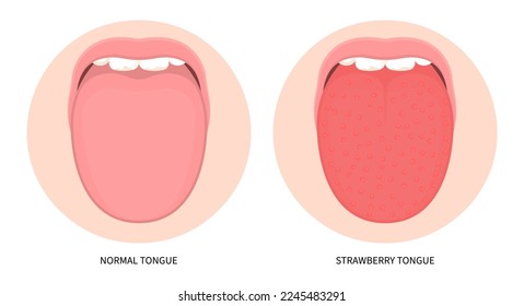 hinchazón de la lengua o enrojecimiento e hinchazón de la lengua que causa la infección por bacterias virales