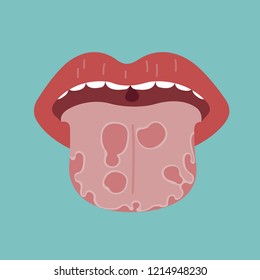 Tongue disease, vector of organ concept.