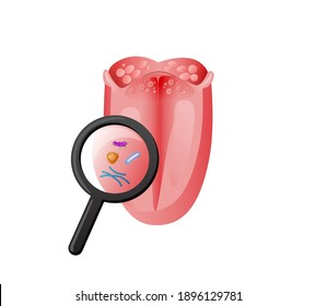 Tongue examination infection and bacteria illustration. Magnifying glass study inflammation red tissue and taste disturbances caused by harmful vector parasites.