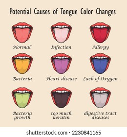 Tongue Health Signs diagnosis medical inspection and tongue chart vector illustration