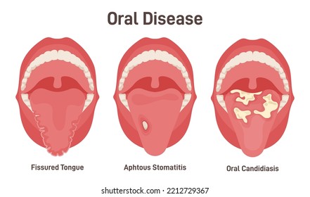 Tongue problems set. Fissured tongue, oral candidiasis and aphthous stomatitis on the tongue. Sore oral cavity, mouth disease symptoms. Flat vector illustration