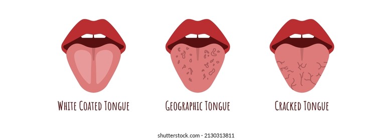 Tongue Problems. White Coated Cranched, Geograohic Tongue. Oral Thrush. Candidiasis On The Tongue. Xerostomia Fungus In The Mouth. Vector