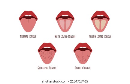 Tongue Problems. White Yellow Coated, Cranched, Geographic Tongue. Oral Thrush. Candidiasis On The Tongue. Xerostomia Fungus In The Mouth. Vector